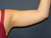 Feel Beautiful - Arm Liposuction plus Skin Tightening - Before Photo